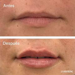 Aumento de labios - Eiviestetic Grupo Policlinica