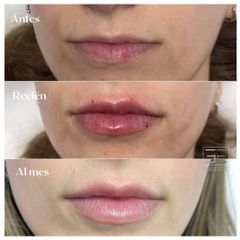 Aumento de labios - Eiviestetic