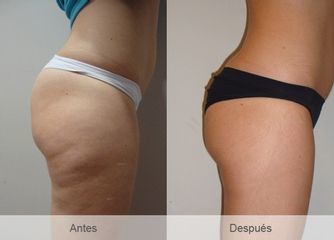 Antes y después mesoterapia  cavitación, masaje manual y electroestimulación.