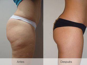 Mesoterapia - 424736