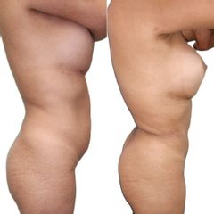 Abdominoplastia - Fertem