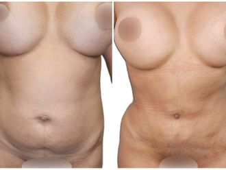 Abdominoplastia antes y después - 871115