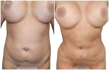 Abdominoplastia - Fertem