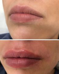 Aumento de labios - Adara Clínicas