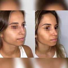 Rinoplastia Ultrasonica - Dr. Mauricio Verbauvede
