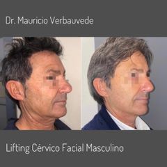Lifting Cervico Facial - Dr. Mauricio Verbauvede