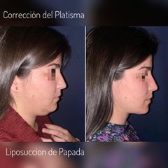 Liposucción de Papada - Dr. Mauricio Verbauvede