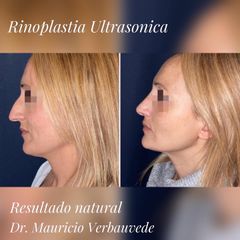 Rinoplastia - Dr. Mauricio Verbauvede