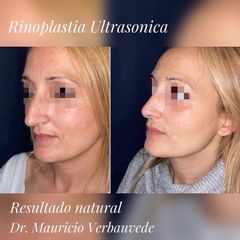 Rinoplastia - Dr. Mauricio Verbauvede