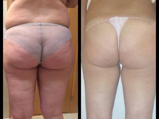 Antes y después tratamiento celulitis