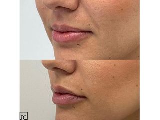 Aumento de labios - Clínica Dr Felipe Castillo