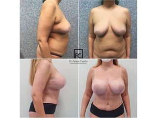 Abdominoplastia - Clínica Dr Felipe Castillo