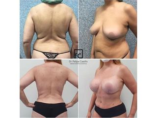 Abdominoplastia