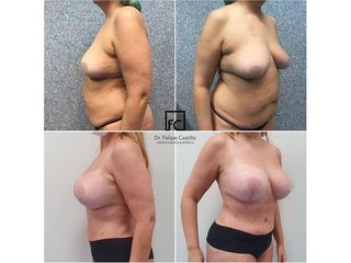 Abdominoplastia - Clínica Dr Felipe Castillo