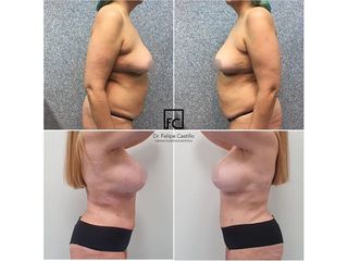Abdominoplastia - Clínica Dr Felipe Castillo