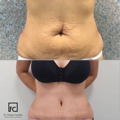 Abdominoplastia - Dr. Felipe Castillo