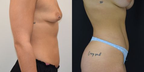 Lipovaser con marcación abdominal - Dr. Felipe Castillo