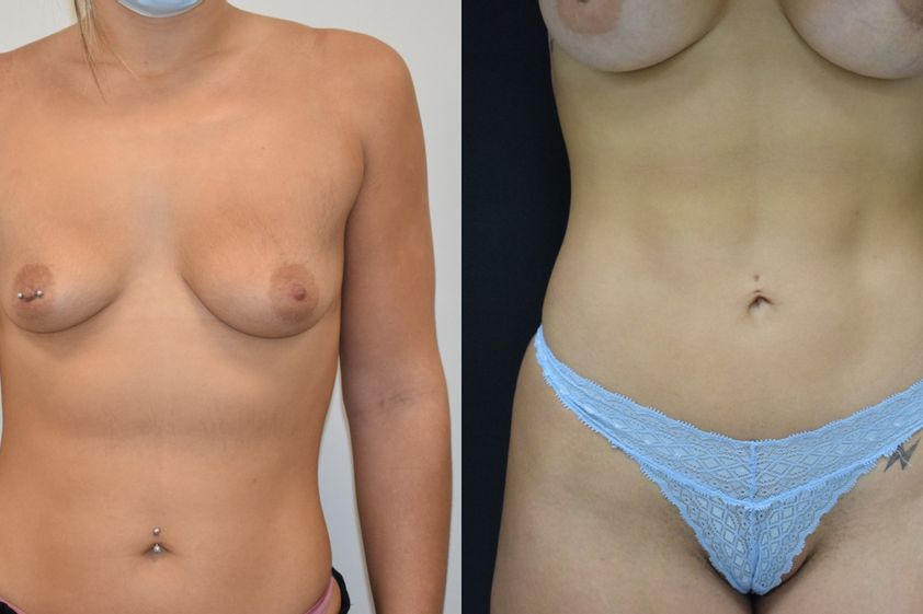 Lipo Vaser antes y después - 793523