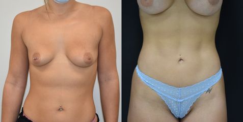 Lipovaser con marcación abdominal - Dr. Felipe Castillo