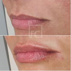 Aumento de labios - Dr. Felipe Castillo