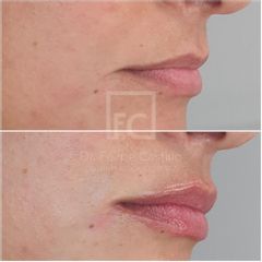 Aumento de labios - Dr. Felipe Castillo