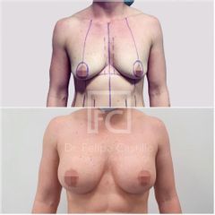 Mastopexia - Dr. Felipe Castillo