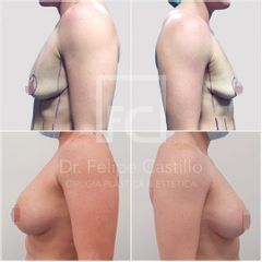 Mastopexia - Dr. Felipe Castillo