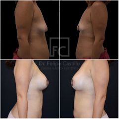 Mastopexia - Dr. Felipe Castillo