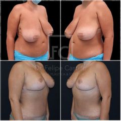 Lipoescultura - Dr. Felipe Castillo