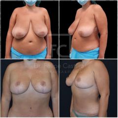 Lipo Vaser - Dr. Felipe Castillo