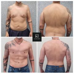 Abdominoplastia - Dr. Felipe Castillo