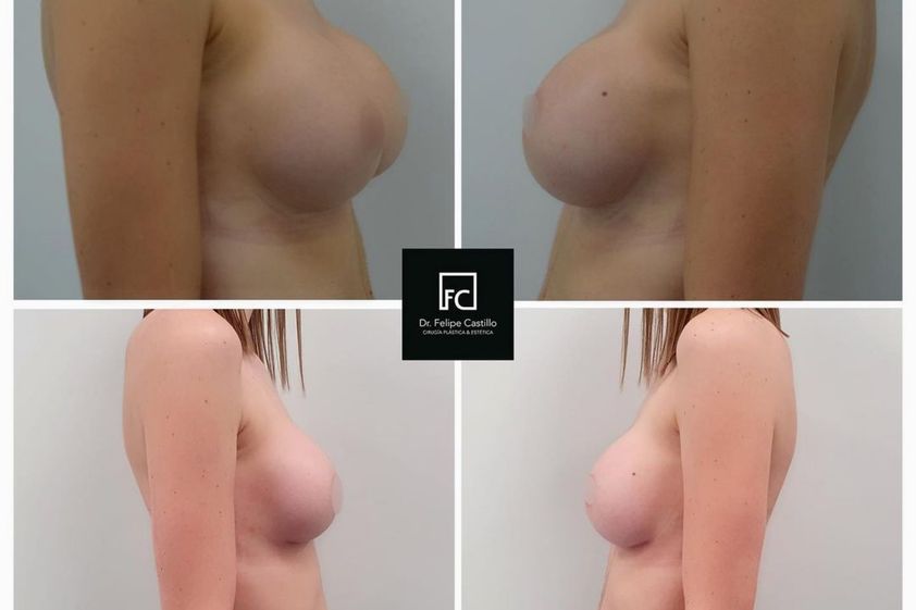 Lipofilling antes y después - 799501