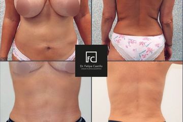 Abdominoplastia - Dr. Felipe Castillo