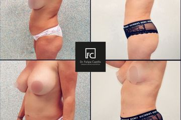 Lipo vaser - Dr. Felipe Castillo