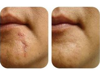 Láser para eliminar cicatriz en el rostro 