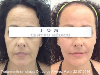 Inductores de Colágeno Una sesión