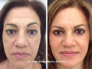 Rejuvenecimiento Facial paciente Dr. Alvarez