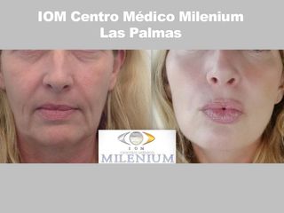 Aumento de labios - IOM Centro Médico Milenium Las Palmas