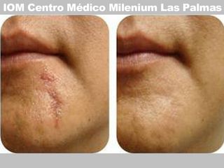 Corrección cicatrices - IOM Centro Médico Milenium Las Palmas