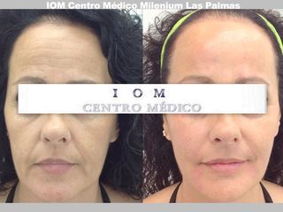 Rejuvenecimiento facial - IOM Clinic
