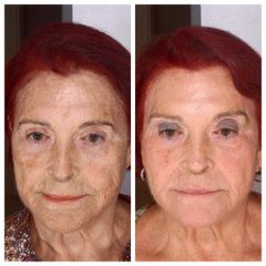 Rejuvenecimiento facial - IOM Clinic