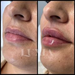 Aumento de labios - LUXIA Clinic