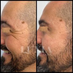 Rellenos faciales - LUXIA Clinic