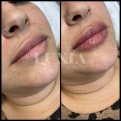 Aumento de labios - LUXIA Clinic