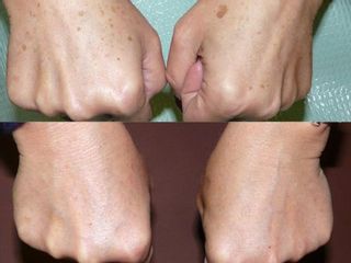 Antes y después Rejuvenecimiento de manos