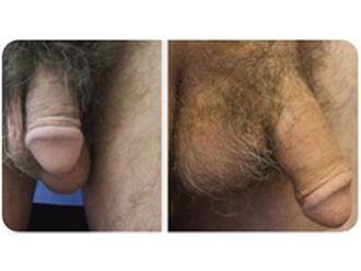 Alargamiento de pene antes y después - 797424