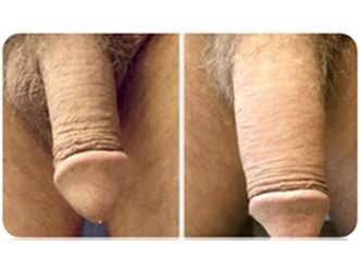 Engrosamiento de pene antes y después - 797426