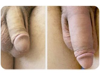 Engrosamiento de pene antes y después - 797429
