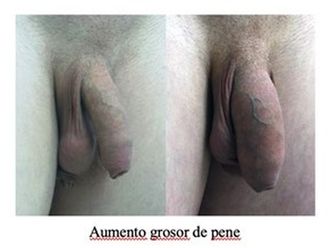 Engrosamiento de pene antes y después - 797663