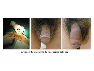 Engrosamiento de pene antes y después - 797664